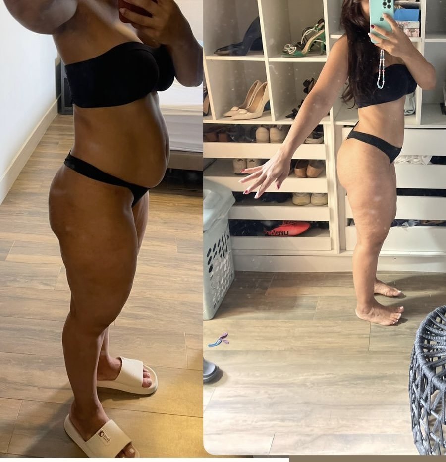Antes e depois de uma paciente do Método SS, de perfil: à esquerda antes, à direita depois