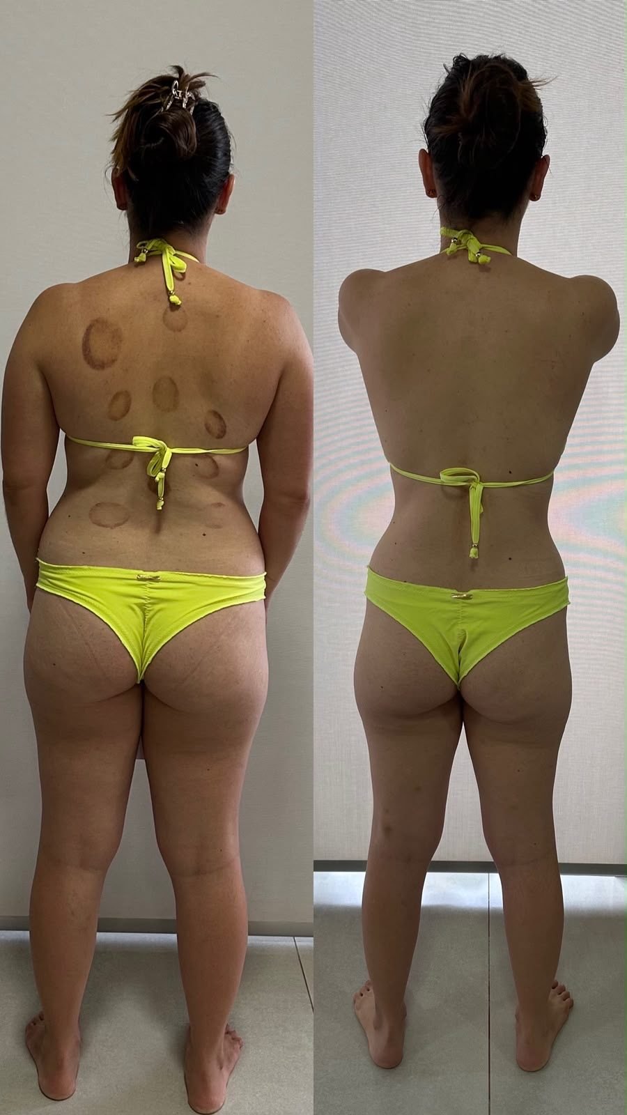 Antes e depois de uma paciente, de costas: à esquerda antes do acompanhamento, à direita depois, com a cintura mais estreita e as costas mais definidas
