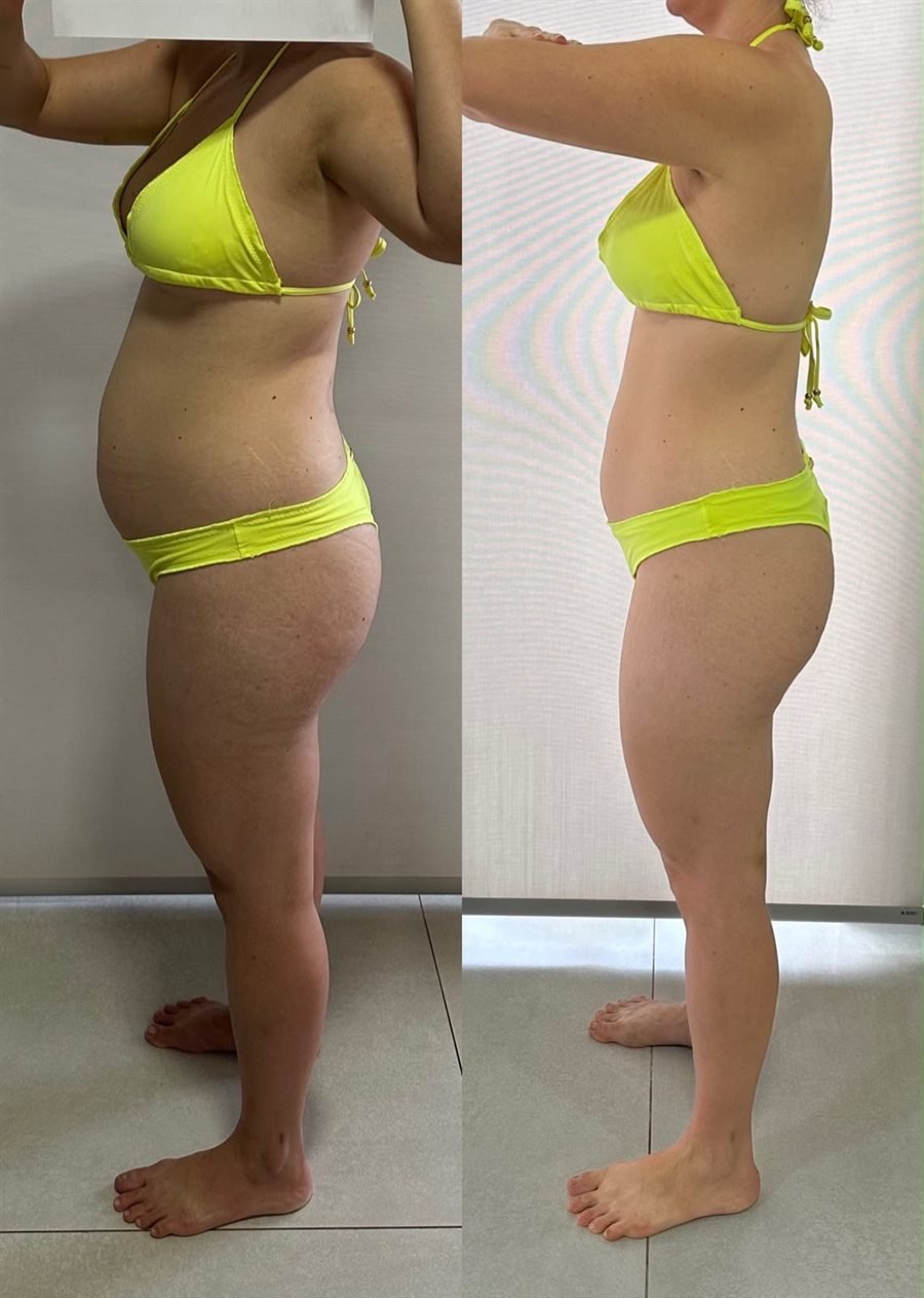 Antes e depois da mesma paciente, de perfil: à esquerda antes do acompanhamento, à direita depois, com o abdômen mais plano